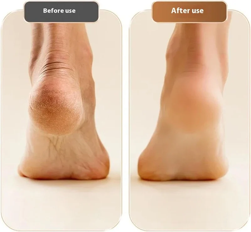 Elektrische Eeltverwijderaar Ergonomisch Design Professionele Voetverzorging Pedicure Thuis Gladde Zachte Voeten | Sansoti
